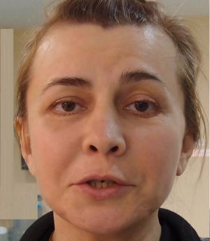 Агибалова-старшая изуродовала лицо неудачной пластикой Агибалова-старшая изуродовала лицо неудачной пластикой