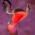 endometriosis